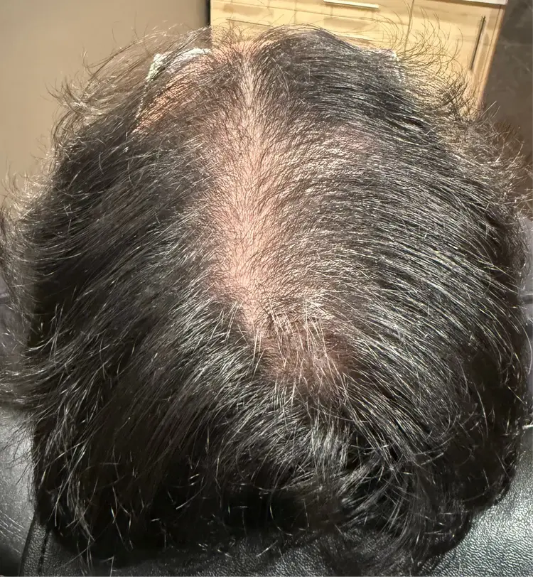 Joe after Folix treatment