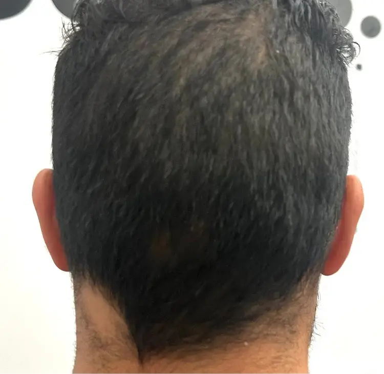 Roman after Folix treatment