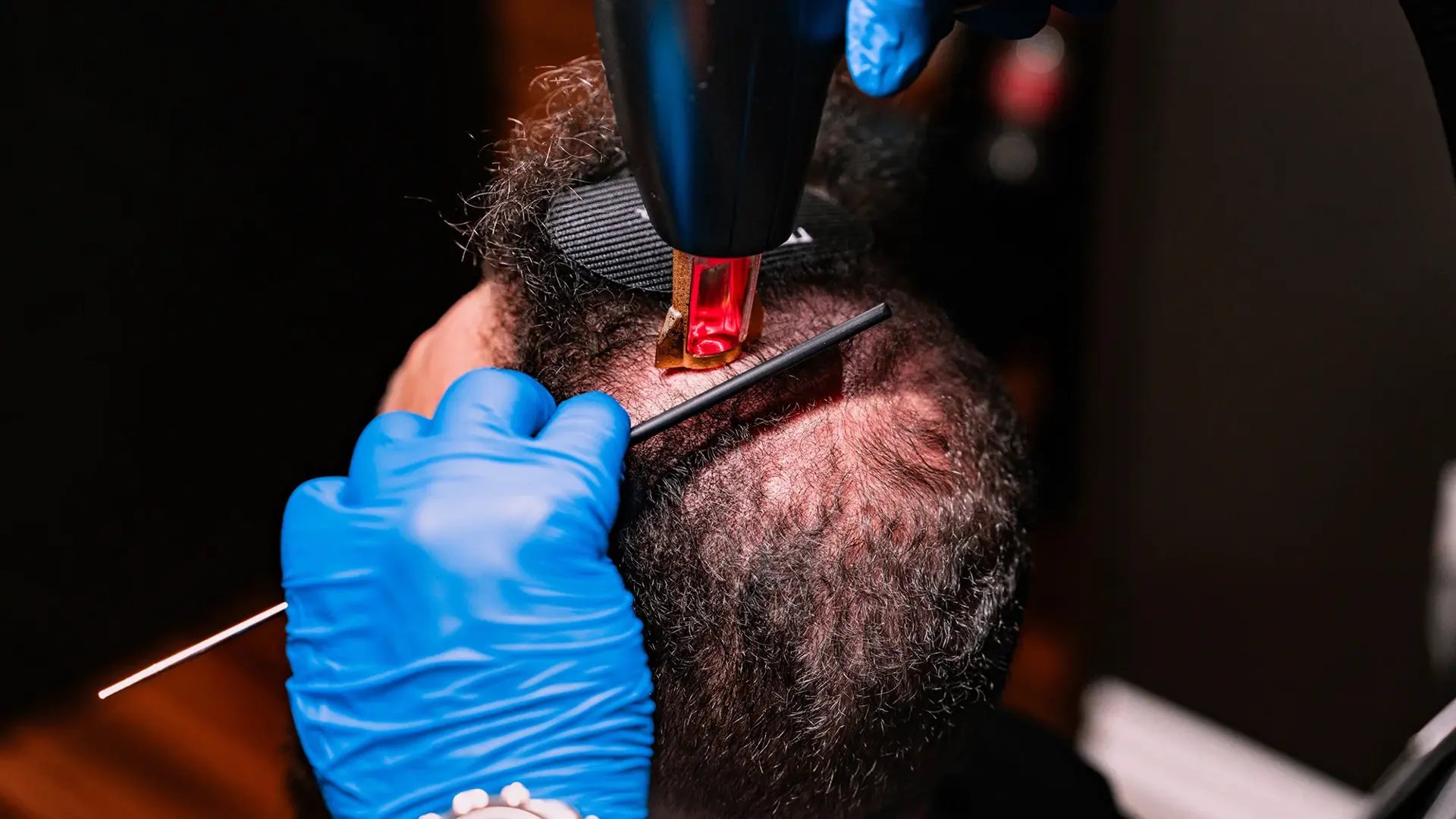 Dr. Valle performing Folix laser treatment