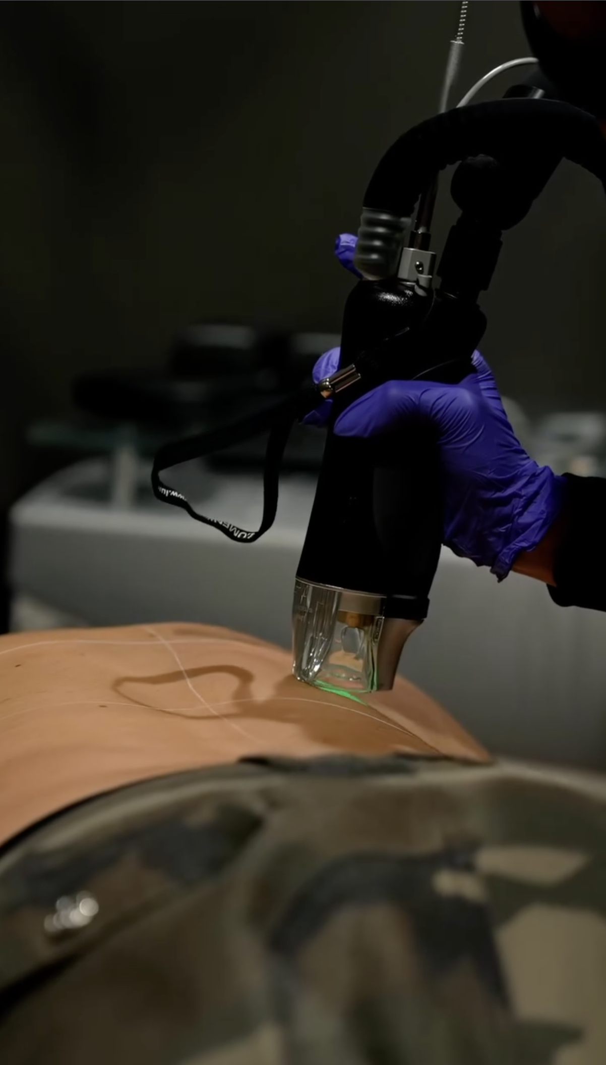 Splendor X™ Laser Hair Removal