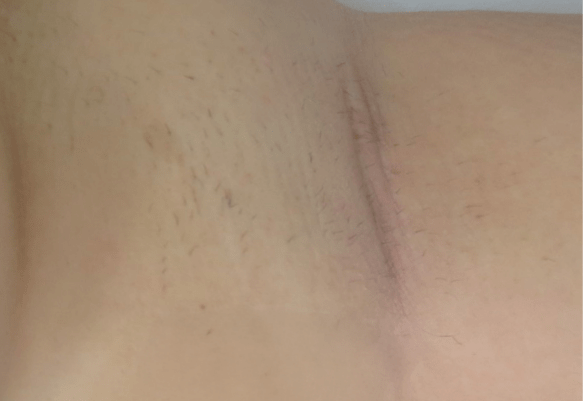 Underarm after Splendor X laser hair removal