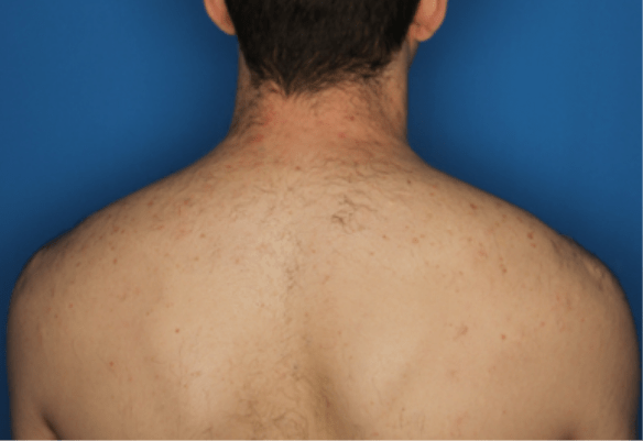 Back after Splendor X laser hair removal