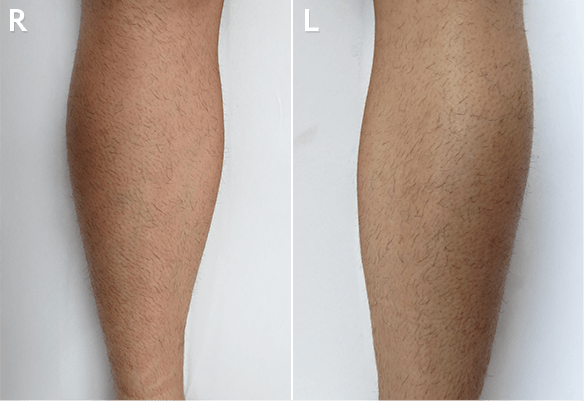 Torso before laser hair removal