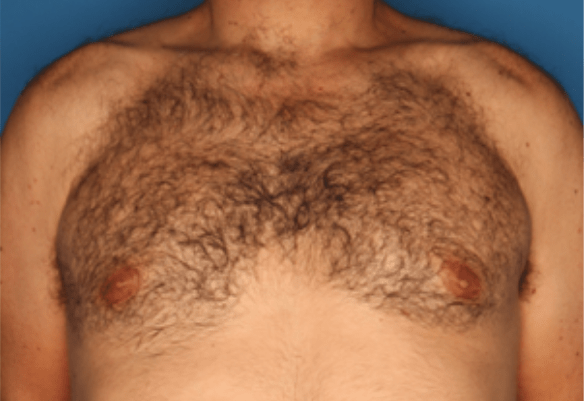 Chest area before laser hair removal