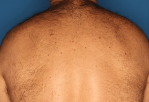 Underarm before laser hair removal